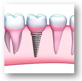 what-is-a-dental-implant-and-bridge