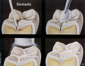 dental-sealants