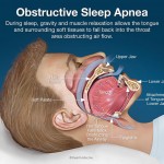 obstructive-sleep-apnea